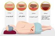 زخم فشاری چیست و راه های پیشگیری از ایجاد و درمان آن چگونه است